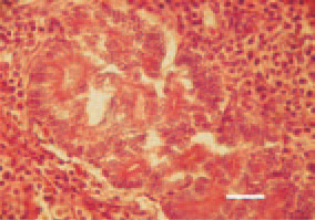 Fig. 27. Extrahepatic cholangiocarcinoma.
Glandular epithelial carcinoma
to the extrahepatic biliary tract. H/E,
Bar = 25 µm.