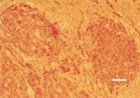 Fig. 28. Glioblastoma, symmetrical
neoplastic foci, brain, hen. H/E, Bar
= 35 µm.
