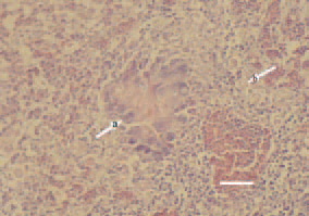 Fig. 3. Histomoniasis, liver, turkey
poult. Initial organization of a necrotic
focus in the liver. A wreath of
foreign-body giant cells (arrow – a)
in the periphery of necrotic area.
Parasites (arrow – b) are also seen
on the tissue cross-section. H/E, Bar
= 35 µm.