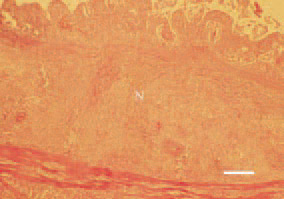 Fig. 5. Histomoniasis, caecum – transverse
cross-section, turkey poult. Coagulative
necrosis (N) affecting the
mucosa and submucosa of the intestinal
wall. H/E, Bar = 100 µm.