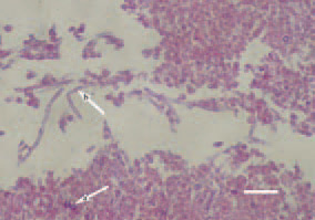 Fig. 1. In acute aspergillosis, fungal
spores (arrow – a) and grown hyphae
(arrow – b) could be observed
among the inflammatory necrotic
masses. H/E, Bar = 30 µm.