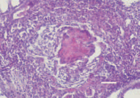 Fig. 2. In the nodular form, the characterisitic
Aspergillus granuloma
structure is seen. A central necrosis,
surrounded by foreign-body giant
cells arranged in a wreath. H/E, Bar
= 30 µm.