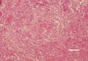 Fig. 5. A shaped Aspergillus granuloma
in the liver of a chicken. H/E,
Bar = 35 µm.