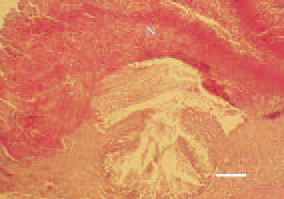 Fig. 1. Candidosis, turkey broiler. A
focal pseudomembranous lesion (N)
prominating over the mucosal surface
of the crop. H/E, Bar = 50 µm.