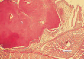 Fig. 2. Candidosis, turkey broiler. A
diphtheroid necrotic mass (N), filling
a biliary lumen of the proventriculus
mucous coat. H/E, Bar = 40 µm.