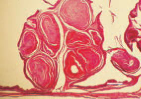 Fig. 2. Hypovitaminosis А, pigeon.
Hyperkeratinization of follicles of B.
Fabricii mucous coat. H/E, Bar = 35
µm.