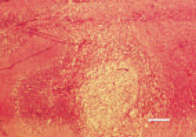 Fig. 1. Histologically, colliquation necroses
are observed, mainly in the
white brain substance of corpus
medularis, appearing as brighter foci,
extensively vacuolized and with a reticular
structure. H/E, Bar = 30 µm. 
