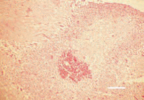 Fig. 2. Haemorrhages of a various
size are observed among the necrotic
tissue. H/E, Bar = 35 µm.