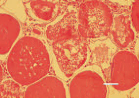Fig. 4. Muscular dystrophy, pectoral
musculature, hen. Hyaline degeneration
of muscle fibres (waxy degeneration).
Swol len homogeneous muscle
fibres, having lost their striated pattern,
with increased eosinophilia.
Centrally, necrobiotic lesions resulting
in muscle cell degradation (Zenker’s
necrosis). H/E, Bar = 25 µm.