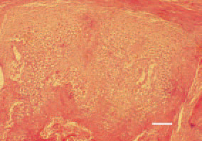 Fig. 7. Tarsometatarsal bone, 35-dayold
broiler chicken, longitudinal crosssection.
Growth of subperiosteal
abnormal masses of hypertrophic
cartilage, resulting in extensive bone
thickening looking like osteopetrosis.
H/E, Bar = 35 µm.