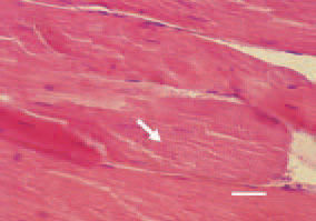 Fig. 1. The condition is resulting from
ischaemic necrosis due to inadequate
blood supply of deep pectoral muscle
groups of a various size. Initial stage
of DPM, characterized with discoid
necrosis (arrow) of muscle fibres,
manifested by separation of single
sarcomeres. H/Е, bar = 25 µm.