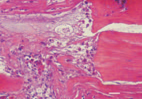 Fig. 3. Degenerative necrobiotic
changes from the Zenker’s necrosis
type, enhanced acidophilia, heterophil
leukocytes and macrophages
among the dead muscle tissue. H/Е,
bar = 35 µm.
