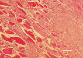 Fig. 6. A late (chronic) lesion. The
place of necrotic musculature is occupied
by fibrous tissue. H/Е, bar =
50 µm.