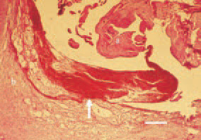 Fig. 1. Haemorrhagies (arrow) between
the tendon (a) and the tendon
sheath (b), H/E, Bar = 50 µm.