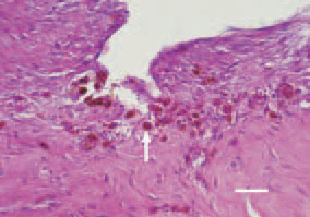 Fig. 3. Macrophages (siderocytes)
(arrow) among the neocollagenous
connective tissue, H/E, Bar = 30 µm.