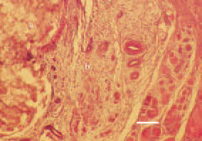 Fig. 5. Axial necrosis (а) of the gastrocnemius
tendon; (b – intact tendinous
tissue), H/E, Bar = 30 µm.