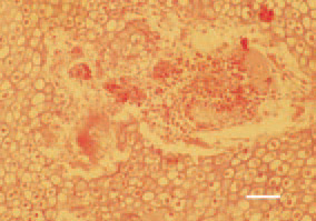 Fig. 5. Necrosis and hemorrhages
among the prehypertrophic cartilage
in a case of dyschondroplasia, that
initiated femoral head necrosis and
fracture in a broiler chicken. H/E, Bar
= 25 µm.