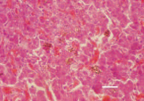 Fig. 3. RRA, liver, the case in Fig. 2.
Congestive hyperaemia and haemosiderosis
in the liver. H/E, Bar = 40
µm.