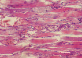 Fig. 3. Longitudinal cross-section,
thigh muscle, chicken, after intoxication
with high doses maduramycin.
Appearance of macrophages and initial
organization of necrotic detritus
occuring after muscle fibre breakdown.
H/E, Bar = 50 µm.
