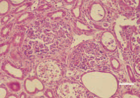 Fig. 4. Inflammatory, degenerative
necrobiotic lesions and urate deposits
in renal tubules. H/E, Bar = 25 µm.
