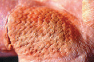 Cellultis. In some cases, the lesions are slightly prominating over the adjacent healthy skin.
