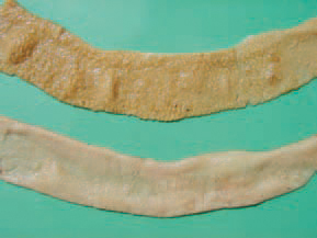necrotic mucosa acquires a greyish-creamy or greenish appearance. Sometimes the mucosa has a flannelette blanket-like appearance