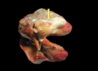 The walls of the gall bladder are thickened, sometimes up to 5-6 cm, and opaque. The state is detected in the last phase of the fattening period or in the slaughterhouse. It is possible to observe CHA as an independent disease or associated with necrotic enteritis.