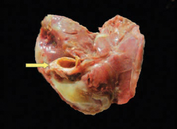 A transverse cross section through the thickened gall bladder wall 