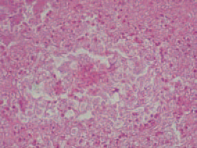 Histologically, the liver lesions are detected at a various stage of development. In the majority of cases, proliferative changes in bile ducts are observed. The overgrown bile ducts form granulomatous struc-tures, surrounded by fine reticular fibres. Centrally, in some granulomas, either initial or advanced degree of necrosis and weak to moderate granulocytic infiltration are observed.