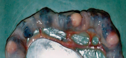 The aetiological agent is Mycobacterium avium, a very resilient and acid-resistant micro-organism. It is resistant to tempe-rature changes, drying, pH changes, to many disinfectants and survives in the soil for years. Along the small intestine, single or multiple sub-serously prominating tubercles are detected.