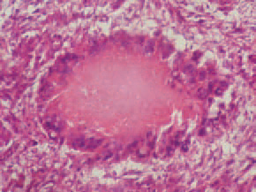 The main mass of the tubercle is composed of epitheloid cells, and peripherally, there are foreign body-type multinucleated giant cells. In older granulomas, central coagulation or caseous necroses are present.