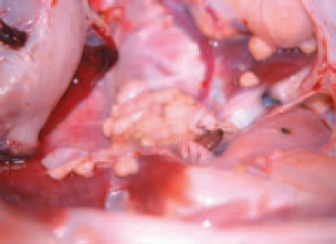 Characteristic features of avian tuberculosis are conglo-merate tubercles (gross and histological appearance). The diagnosis is based upon the complex evaluation of history, persisting lethality in adult flocks and the pathoanatomical findings. Avian tuberculosis should be differentiated from neoplastic diseases, coligranu-loma (Hjarre's disease), pullorum disease etc. The treatment is not advised, as the disease is contagious for men.