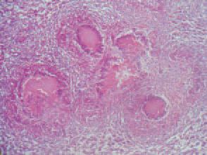 Characteristic features of avian tuberculosis are conglo-merate tubercles (gross and histological appearance). The diagnosis is based upon the complex evaluation of history, persisting lethality in adult flocks and the pathoanatomical findings. Avian tuberculosis should be differentiated from neoplastic diseases, coligranu-loma (Hjarre's disease), pullorum disease etc. The treatment is not advised, as the disease is contagious for men.