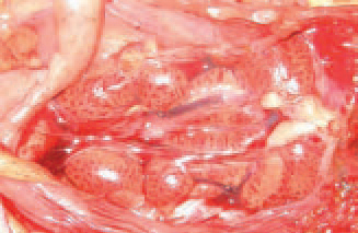 The kidneys are enlarged, pale and mottled with multiple haemorrhages.