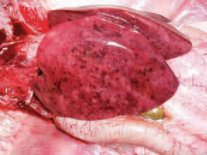 The liver is enlarged, crumbly and mottled with multiple haemorrhages, varying from petechiae to ecchymoses. Dead birds are in a good condition, with pale skin. Once having appeared in the farm, the infection is often recurring in other flocks. The HEV infection in turkeys results in a transient immunosuppression and consequently, a secondary E. coli septicaemia