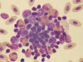 The staining of peripheral blood smears reveals a picture, characte-ristic for septicaemia. The typical gross lesions and the history of the disease allow making a tentative diagnosis for HE. The histological detection of intranuclear inclusion bodies in the reticuloendothelial cells of the spleen or intestines confirms the diagnosis. For identification of the HEV, the agar gel precipitation method could be used. The viral antigen could be detected in fresh or frozen spleen tissue, diluted 1:1 with saline or in sera obtained from diseased turkeys. HE should be distinguished from other cases of severe enteritis in turkeys, acute E. coli septicaemia and some other septicaemic states (streptococcosis, fowl cholera etc.). Within weeks after the beginning of the disease, an appropriate antibiotic therapy should be initiated for prevention of secondary E. coli septicaemia. Practically, there is no effective therapy for HE in turkeys.