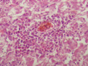 The nephrotropic strains of the IB virus cause severe inflammatory and dystrophic necrobiotic damages of kidneys: urolithiasis (229), interstitial nephritis (230), haemorrhages (231) that considerably increase the death rate. Under natural conditions, only hens are infected. Non-immune birds of all ages are susceptible. The disease is even seen in vaccinated flocks. The serological methods (VN, ELISA etc.) are widely used in the diagnostics. At present, PCR is used for rapid identification of IB virus serotypes. IB should be distinguished from other acute respiratory disease as ND, laryngotracheitis and infectious coryza. The vaccination with live or killed vaccines is effective only if they contain the respective serotype of the virus for the given region.