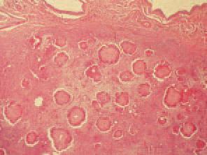 Histologically, among the oedematous subcutaneous connective tissue, multiple granulomas are detected.