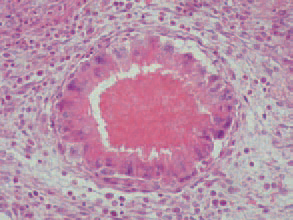 central zone of granulomas is an inflammatory necrotic detritus with many eosinophilic leukocytes delineated within.
