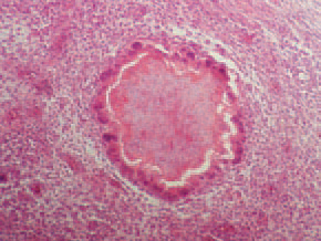 , as a crown, multinuclear giant cells of a foreign-body type are arranged, with fibroblast fibrocyte growths around them.