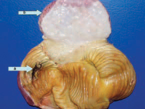 The caustic effect of some fusariotoxins is the cause of the commonly detected erosions and ulcers in gizzard cuticulum (arrow a). Note the thickened wall of the proventriculus (arrow b).