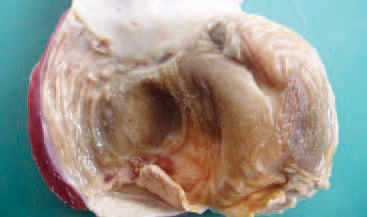 The cuticulum of the gizzard in broilers whose diet contains Fusarium toxins, is frequently with a linear appearance and under the ulcerations, the subcuticular surface is seen.