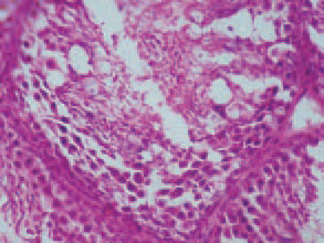 Microscopically, the testes of cocks with zearalenone fusario-toxicosis, show a fatty infiltration and atrophy of the germinative epithelium with the exception of the basal layer as well as interruption of the spermatogenesis.