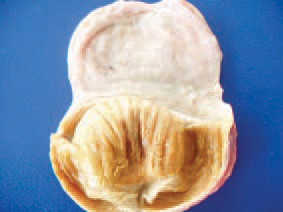 Frequently, the proventriculus is dilated at a various extent, its wall is thickened and in its mucous coat, fibrinous necrotic and haemorrhagic lesions are detected. The prevention from mycotoxicoses requires the detection and control of mycotoxin-contaminated forage components, avoidance of forage moulding and thus, the formation of mycotoxins. A screening of cereals and forages for the presence of some mycotoxins (aflatoxin, T-2 toxin, zearalenone) via ELISA is advised. The application of commercial mycotoxin-binding agents could possibly reduce the effects of some of them. In some mycotoxicoses, the systemic requirements for vitamins, minerals and proteins are increased and they could be balanced by supplementation with forage or water.