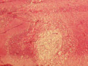 Histologically, colliquative necroses in the white brain substance (444), haemorrhages (445) and multiple thrombosed blood vessels (446) in the cerebellum are detected. Vitamin E and the selenium-containing enzyme glutathione peroxidase preserve the cellular membrane from being destructed by peroxides and other oxidants, produced as metabolic by-products. Peroxides are derivatives of polyunsaturated fatty acids in forages.