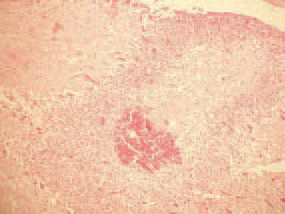 Histologically, colliquative necroses in the white brain substance (444), haemorrhages (445) and multiple thrombosed blood vessels (446) in the cerebellum are detected. Vitamin E and the selenium-containing enzyme glutathione peroxidase preserve the cellular membrane from being destructed by peroxides and other oxidants, produced as metabolic by-products. Peroxides are derivatives of polyunsaturated fatty acids in forages.