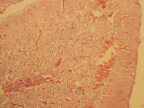 Histologically, colliquative necroses in the white brain substance (444), haemorrhages (445) and multiple thrombosed blood vessels (446) in the cerebellum are detected. Vitamin E and the selenium-containing enzyme glutathione peroxidase preserve the cellular membrane from being destructed by peroxides and other oxidants, produced as metabolic by-products. Peroxides are derivatives of polyunsaturated fatty acids in forages.