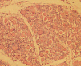  Muscular dystrophy.
The signs are usually unapparent, but locomotor problems could occur. The pectoral and thigh muscles are most commonly affected, and in them, white or yellowish muscle fibres are found, responsible for the striated appearance of skeletal muscles (447), due to Zenker's necrosis (448).
