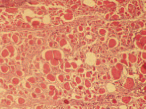 Histologically, the altered muscle fibres are enlarged at a various extent, markedly eosinophilic with rectic or lacking nuclei. At a more advanced stage, among the necrotized tissue, inflammatory reaction and replacement of atrophied fibres with fat or fibrous tissue could be seen.