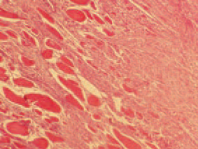 Histologically, the altered muscle fibres are enlarged at a various extent, markedly eosinophilic with rectic or lacking nuclei. At a more advanced stage, among the necrotized tissue, inflammatory reaction and replacement of atrophied fibres with fat or fibrous tissue could be seen.